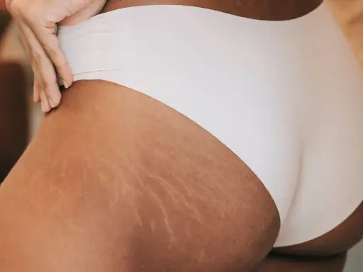 Pelle con inizio smagliature gravidanza, un segno naturale del corpo che cambia.