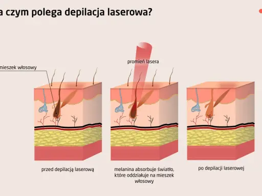 Bezpieczna depilacja laserowa? Rozwiej wątpliwości z ekspertem.