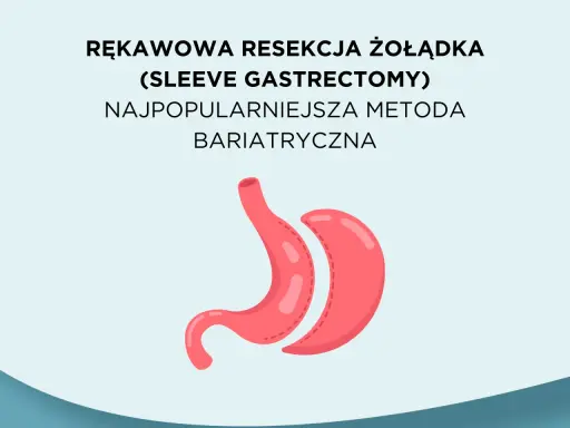 Rękawowa resekcja żołądka, najpopularniejsza metoda bariatryczna, przedstawiona jako stylizowany obraz żołądka.
