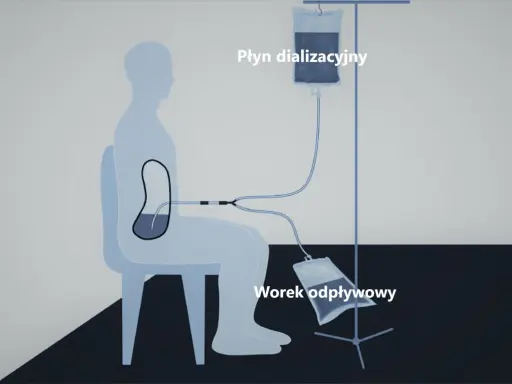 Schemat dializy otrzewnowej: cewnik Tenckhoffa w jamie otrzewnej pacjenta, podłączony do worka z płynem dializacyjnym i worka odpływowego.