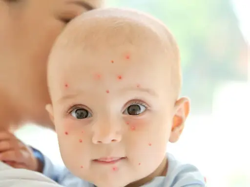 Un bébé est tenu par sa mère, son visage est couvert de petites taches rouges de varicelle.