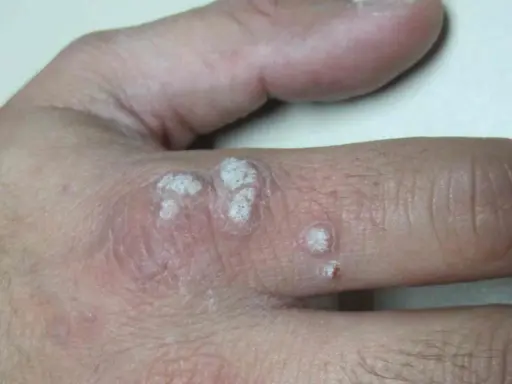 Verrugas en la mano, con aspecto escamoso y blanquecino. La diferencia entre verruga y condiloma es importante para el diagnóstico.