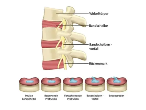 Illustration zeigt Wirbelkörper und Bandscheiben. Unten sind Stadien von Bandscheibenvorfällen abgebildet, von intakt bis Sequestration.