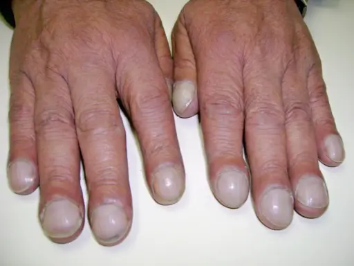 Dita gonfie e unghie arrotondate, segni che possono indicare fibrosi cistica alle mani.