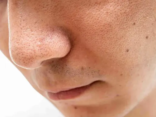 Gros plan sur un nez et une bouche, montrant des pores dilatés et quelques points noirs sur le visage.
