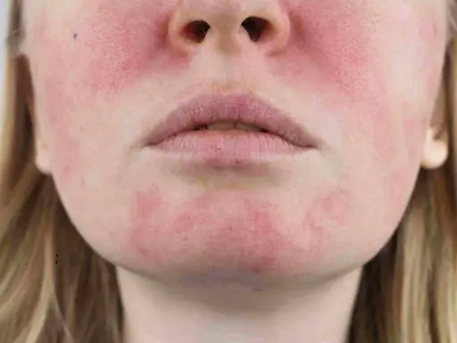 Une tache rouge sur le visage, près des lèvres et des joues, suggère une irritation cutanée.