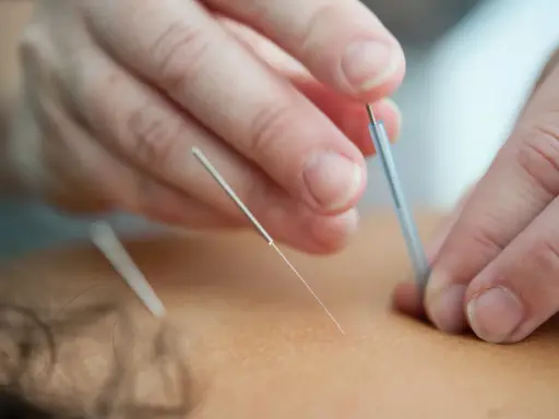 Dłonie terapeuty wprowadzają igły do akupunktury. Często zadajemy sobie pytanie, jak często stosować suche igłowanie dla najlepszych efektów.