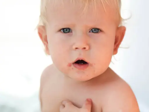 Visage d'un bébé aux yeux bleus, présentant des rougeurs autour de la bouche, possiblement un eczéma bouche bébé.