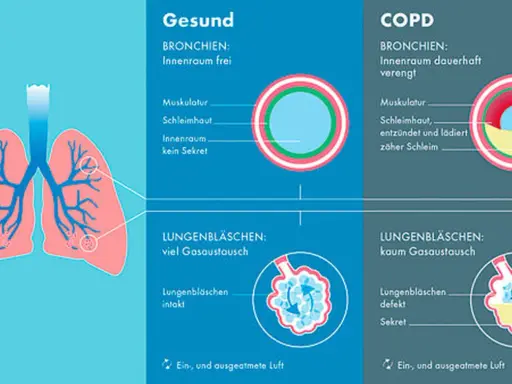 Vergleich gesunder Lungen mit COPD: Verengte Bronchien und defekte Lungenbläschen bei COPD erschweren den Gasaustausch.