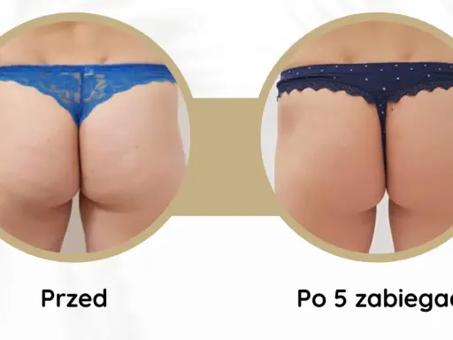 Endermologia: Jak się przygotować? Twój poradnik krok po kroku