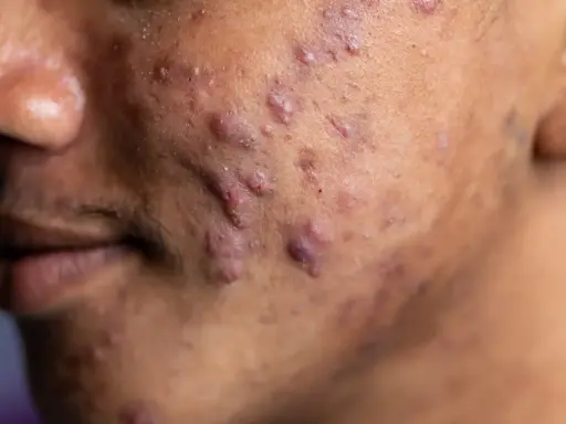Gros plan sur une peau marquée par de nombreux boutons d'acné, dont un acné nodule particulièrement visible.