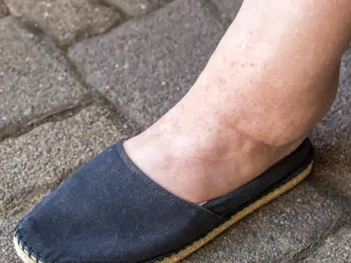 Spuchnięta kostka i stopa w czarnym bucie, objaw problemów z nerkami.