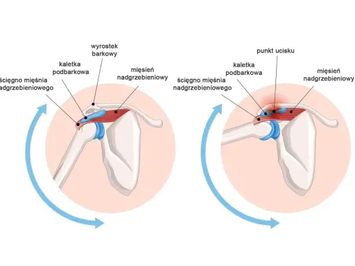 Anatomia barku: ścięgno mięśnia nadgrzebieniowego w zdrowej pozycji i podczas ucisku, pokazujące jego relację z kaletką podbarkową i wyrostkiem barkowym.