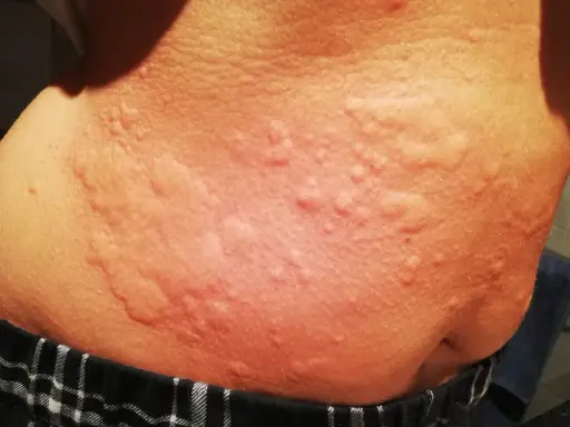 Piel con erupciones rojas y elevadas, posibles síntomas de ácaros en la cama.