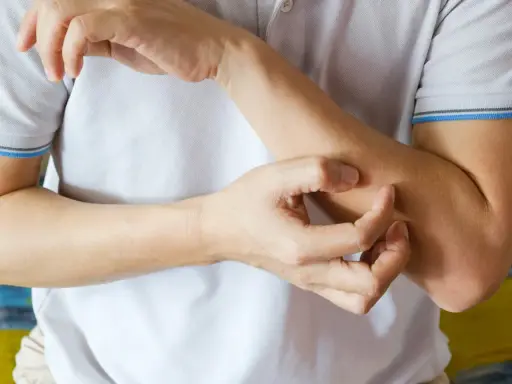 Dłoń drapiąca przedramię, mogące być jednym z objawów skórnych HIV.