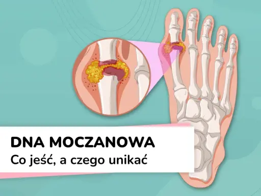 Dna moczanowa: powiększony staw palucha z kryształkami moczanowymi. Wysoki kwas moczowy może prowadzić do bólu.