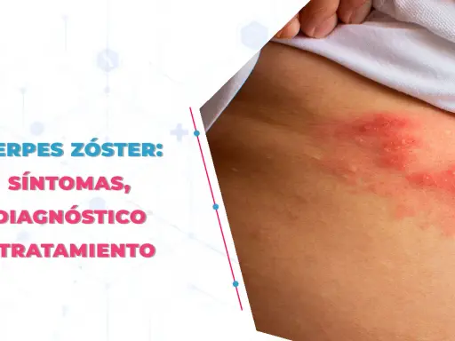 Herpes zóster: Medicamentos esenciales para evitar el dolor crónico
