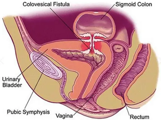 Anatomical diagram showing a colovesical fistula, a connection between the colon and bladder.