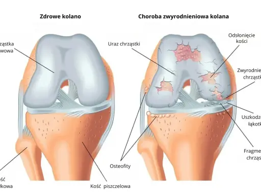 Porównanie zdrowego kolana z kolanem dotkniętym gonartrozą. Widać uszkodzenia chrząstki, odsłonięte kości i osteofity.