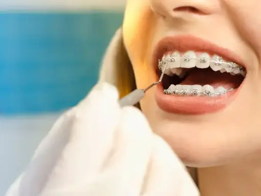 Uśmiech z aparatem na dolne zęby. Dentysta sprawdza zęby pacjentki.