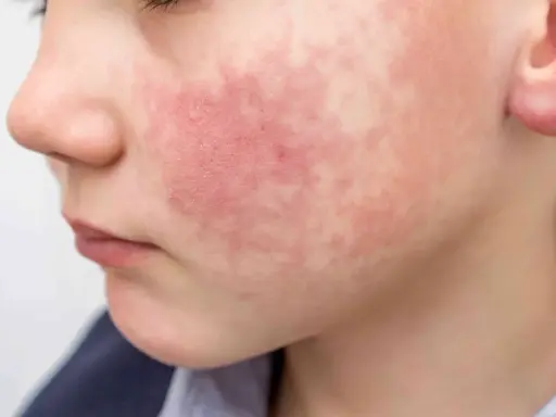 Rostro de niño con erupción roja y escamosa, síntoma del virus del tortazo.