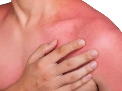 En person med kraftigt solbränd, röd hud på axlar och bröst. Huden ser ut att ha feber efter för mycket sol.