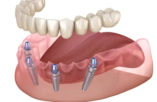 Górna proteza zębowa opiera się na implantach wszczepionych w szczękę. Widok z boku ukazuje cztery implanty.