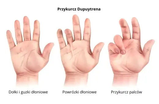 Trzy dłonie ilustrują postępujące stadia przykurczu Dupuytrena: od niewielkich guzków, przez powrózki, aż po zgięte palce.