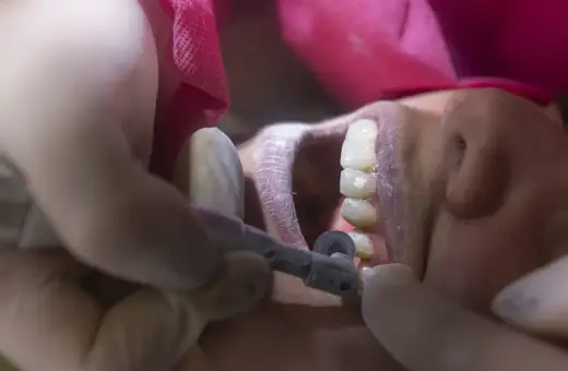 Dentysta wygładza ostry brzeg kości po usunięciu zęba, używając małego wiertła.