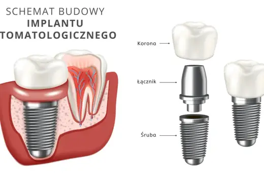 Schemat budowy implantu stomatologicznego. Dowiedz się, ile kosztuje implant zęba 6 i jak jest zbudowany: śruba, łącznik i korona.
