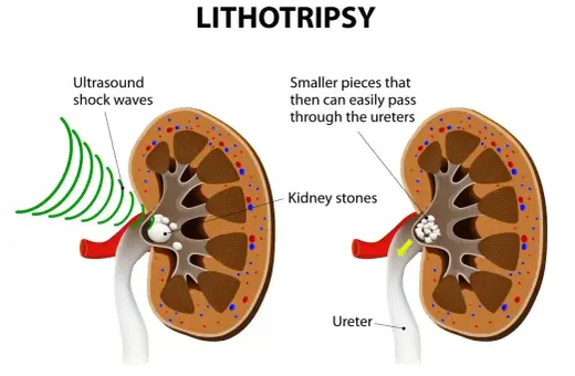 Litotrypsja w urologii: fale ultradźwiękowe rozbijają kamienie nerkowe na mniejsze fragmenty, które łatwiej przechodzą przez moczowód.