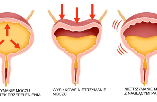 Ilustracja pokazuje różne rodzaje nietrzymania moczu: przepełnienie, wysiłkowe i z nagłymi parciami.