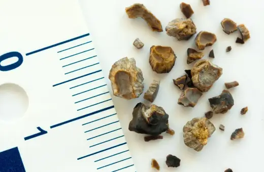 Kawałki kamieni nerkowych, w tym największy kamień nerkowy, obok linijki z oznaczeniem 1 cm.