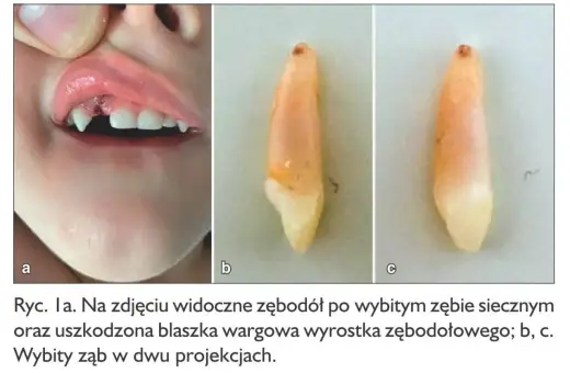Wypadanie zębów mlecznych u 5 latka: widoczny zębodół po wybitym zębie i uszkodzona warga. Obok wybity ząb w dwóch ujęciach.