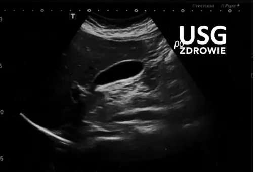 Obraz USG przedstawia pęcherzyk żółtkowy, ważny element układu trawiennego.