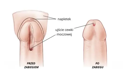 Przed i po zabiegu: widok penisa z napletkiem i ujściem cewki moczowej.