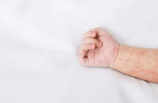 Różowa, nieswędząca wysypka u dziecka na białym tle. Skóra na rączce dziecka jest pokryta drobnymi, czerwonymi plamkami.
