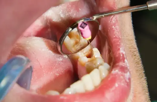 Zgorzel zęba w odbiciu lusterka dentystycznego. Widoczny jest ząb z ubytkiem i narzędzie stomatologiczne.