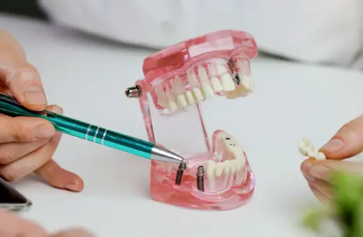 Pokazano model szczęki z implantami. Dyskutujemy, co zamiast implantu, prezentując alternatywne rozwiązania protetyczne.
