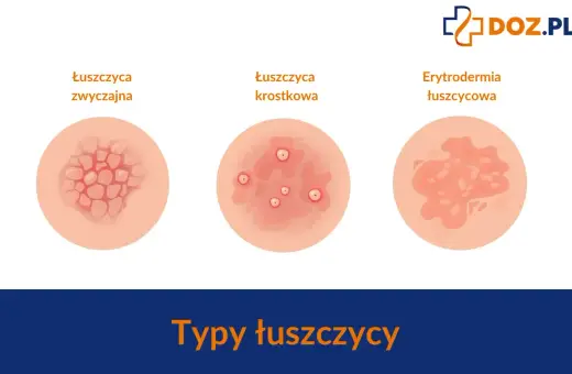 Ilustracje pokazują różne typy łuszczycy: zwyczajną, krostkową i erytrodermię łuszczycową. Ważne, by znać objawy łuszczycy u dzieci.