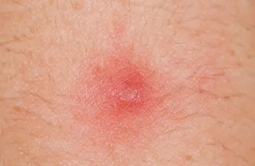 Czerwona, zapalna krostka na skórze, która może wymagać leczenia detreomycyną.