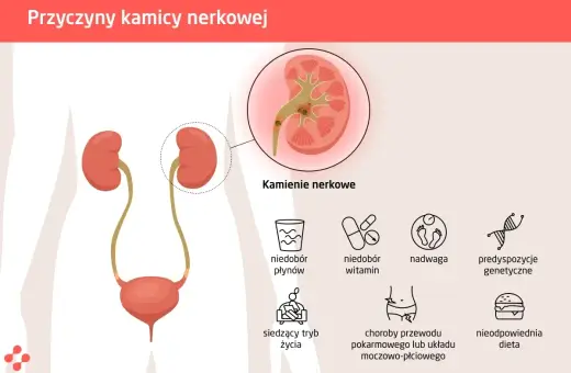 Ilustracja przedstawia przyczyny kamicy nerkowej, w tym kamienie nerkowe, niedobór płynów, witamin, nadwagę, siedzący tryb życia, choroby układu pokarmowego i nieodpowiednią dietę.