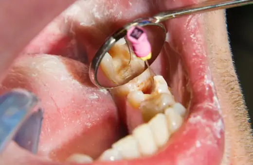 Lekarz stomatolog bada ząb, który daje pulsujący ból zęba. Widać narzędzia dentystyczne i wnętrze jamy ustnej.