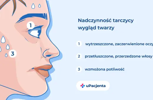 Nadczynność tarczycy: wytrzeszczone oczy (1), przetłuszczone włosy (2), wzmożona potliwość (3).