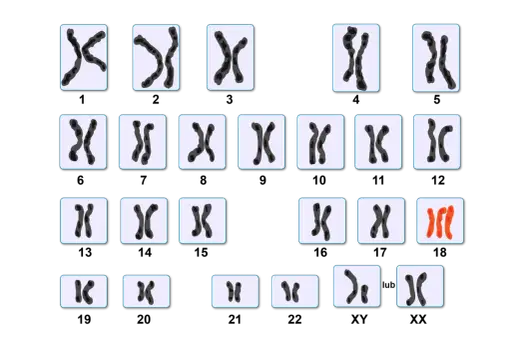 Kariotyp przedstawia pary chromosomów, w tym trzy chromosomy w parze 21, co może wskazywać na zespół Downa.