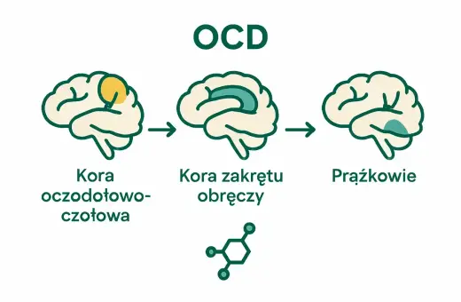 Ilustracja przedstawia mózg z zaznaczonymi obszarami, sugerującymi zmiany związane z OCD chorobą.