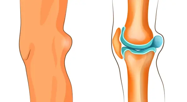 Knie mit Bakerzyste, die eine Schwellung hinter dem Kniegelenk zeigt. Die rechte Seite illustriert das Kniegelenk und die mögliche Bakerzyste, die eine Behandlung erfordert.