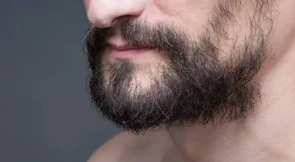 Gros plan sur le menton d'un homme, montrant une barbe foncée et clairsemée. On aperçoit un trou dans la barbe, signe d'une perte de barbe.