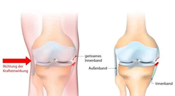 Illustration zeigt einen **Innenbandriss Knie**. Links die Kraftrichtung, rechts das gerissene Innenband im Vergleich zum gesunden.
