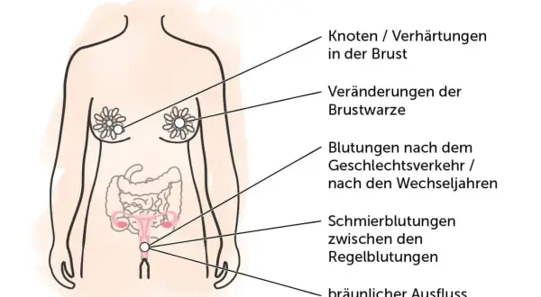 Illustration zeigt Symptome, die auf einen Unterschied zwischen Tumor und Karzinom hinweisen können: Knoten in der Brust, Brustwarzenveränderungen, Blutungen und Ausfluss.